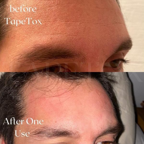 TapeTox Natural Wrinkle Smoothers